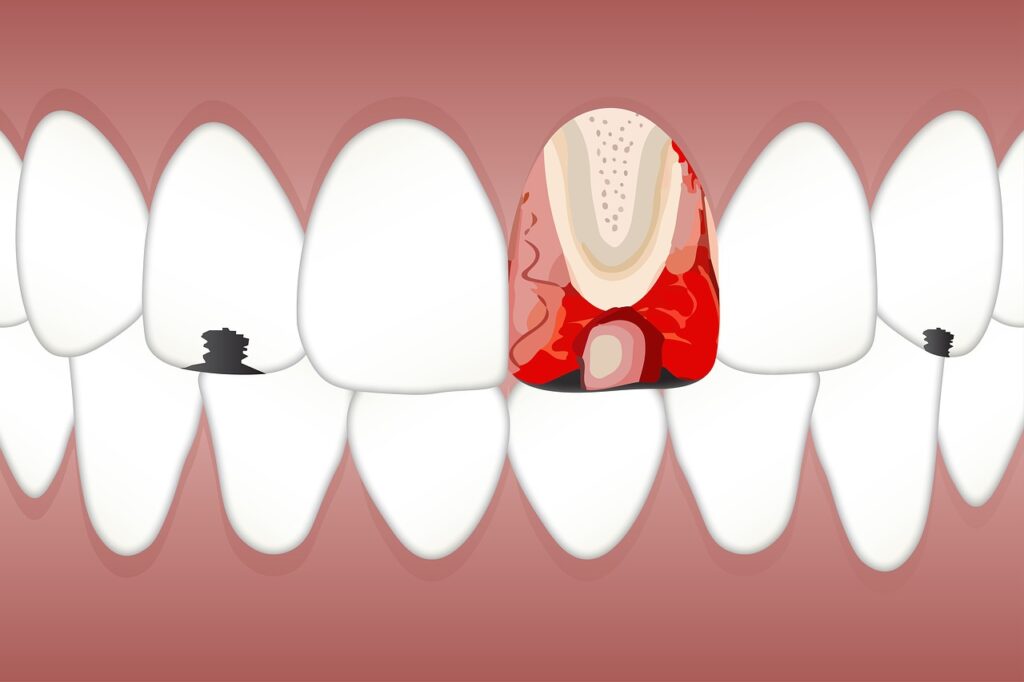 dental, pulpitis, white-3599745.jpg